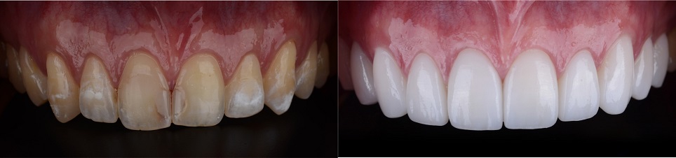 veneers before and after 